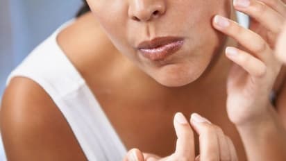 Skin Care : മുഖത്ത് വൈറ്റ്ഹെഡ്സും ബ്ലാക്ഹെഡ്സും വരുന്നത് തടയാൻ ചില മാര്‍ഗങ്ങള്‍