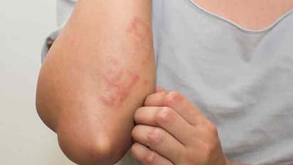 వర్షాకాలంలో ఫంగల్ ఇన్ఫెక్షన్స్ రావొద్దంటే ఇలా చేయండి