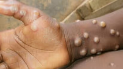 Monkeypox: ஷாக்கிங் நியூஸ்! தமிழகத்தில் ஒருவருக்கு குரங்கம்மை அறிகுறி? பரவியது எப்படி? பரபரப்பு தகவல்! 