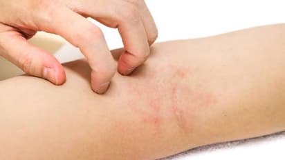 Skin Infections : സ്കിൻ ചൊറിച്ചില്‍- അണുബാധ; ധരിക്കുന്ന വസ്ത്രത്തിനും പങ്കുണ്ട്