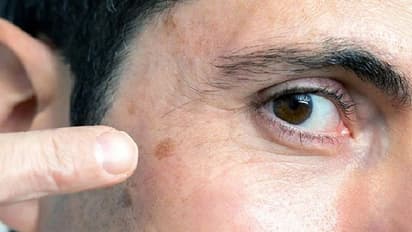 Cancer Disease : 'സ്കിൻ ക്യാൻസര്' കൂടുതല് കാണുന്നത് പുരുഷന്മാരിലോ?