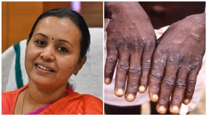 Monkey Pox in Kerala ಕೇರಳದಲ್ಲಿ 2ನೇ ಮಂಕಿಪಾಕ್ಸ್ ಪ್ರಕರಣ ಪತ್ತೆ!