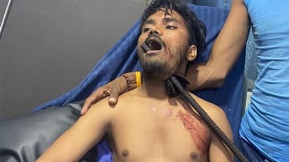 छत से गिरने पर गर्दन में छेद करते हुए मुंह से बाहर निकला 4 फीट का सरिया, फिर 2 घंटे में हो गया चमत्कार