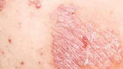 World Psoriasis Day 2022 : ചർമ്മത്തെ ബാധിക്കുന്ന സങ്കീർണമായ അസുഖം; സോറിയാസിസിന്റെ ലക്ഷണങ്ങൾ എന്തൊക്കെ?