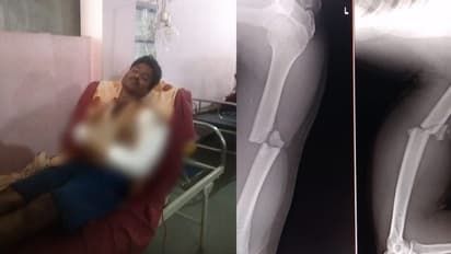 ಬೆಳಗಾವಿ: ಕಾಡುಕೋಣ ಹಿಡಿಯಲು ಹೋಗಿ ಕೈ ಮೂಳೆ ಕಟ್: ತುತ್ತು ಅನ್ನಕ್ಕಾಗಿ ಅರಣ್ಯ ಇಲಾಖೆ ನೌಕರ ಪರದಾಟ