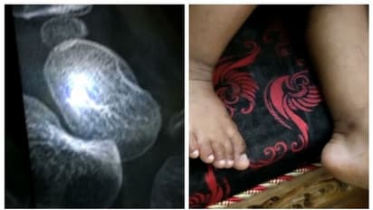 ഡ്രിപ്പ് ഇടാന് കുത്തിയ സൂചി കുഞ്ഞിന്റെ കാലില് ഒടിഞ്ഞ് തറച്ചു, ശസ്ത്രക്രിയ നടത്തി സൂചി പുറത്തെടുത്തു