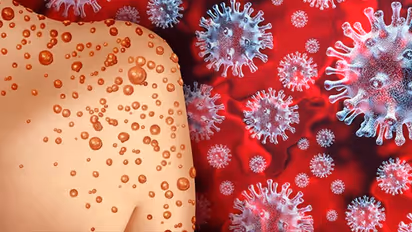 দেশে বাড়ছে মাঙ্কিপক্সে আক্রান্তের সংখ্যা, পরিস্থিতি মোকাবিলায় টাস্ক ফোর্স গঠন মোদী সরকারের