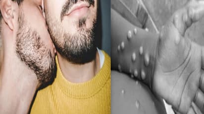 समलैंगिक और मंकीपॉक्स का क्या है कनेक्शन, WHO ने जारी की ये चेतावनी