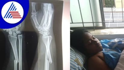 ಹೆದ್ದಾರಿ ಹೊಂಡಕ್ಕೆ ಬಿದ್ದು ಬಲ ಗೈ ಮುರಿತ: ಪರೀಕ್ಷೆ ವಂಚಿತಳಾದ ವಿದ್ಯಾರ್ಥಿನಿ!