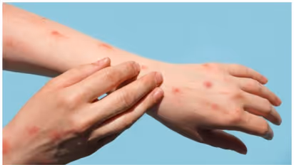 WHO announces 'mpox' as synonym for Monkeypox; check details 