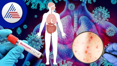 ಮಂಕಿಪಾಕ್ಸ್ ಭೀತಿಯಲ್ಲಿ ಕೋವಿಡ್ ಮರೀಬೇಡಿ, ಮರುಸೋಂಕಿನಿಂದ ಹೆಚ್ತಿದೆ ಅಪಾಯ !