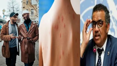 সমকামী মানেই মাঙ্কিপক্সের বাহক নন, বার্তা স্পষ্ট করল বিশ্ব স্বাস্থ্য সংস্থা