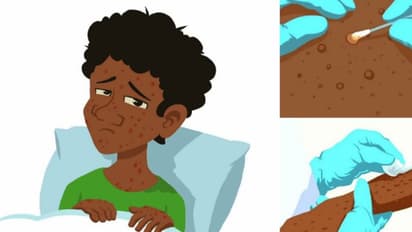 വയനാട്ടിൽ നിരീക്ഷണത്തിൽ കഴിഞ്ഞ യുവതിക്ക് മങ്കിപോക്സില്ല; യുവതിയെ ആശുപത്രിയിൽ നിന്ന് വിട്ടയച്ചു