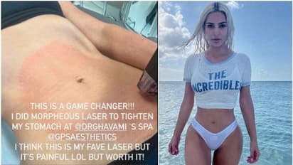 ಹೊಟ್ಟೆ ದಪ್ಪ ಆಗದಂತೆ ಸರ್ಜರಿ ಮಾಡಿಸಿಕೊಂಡ ಟಿವಿ ಸ್ಟಾರ್ ಕಿಮ್ ಕರ್ದಾಶಿಯನ್