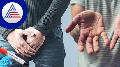 Monkeypox Symptoms: ಜನನಾಂಗದಲ್ಲೂ ಕಾಣಿಸಿಕೊಳ್ಳುತ್ತೆ ಕೆಂಪು ಗುಳ್ಳೆ !