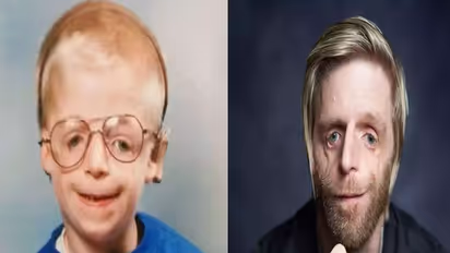 रुला देगी इनकी कहानीः एलियन जैसा चेहरा देख मां-बाप ने छोड़ा, 'यशोदा' बन दूसरी मां ने पाला