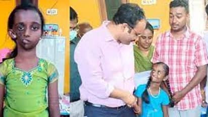 அரிய வகை முகச்சிதைவு நோயால் பாதிக்கப்பட்ட சிறுமிக்கு அறுவை சிக்கிச்சை.. முதலமைச்சர் உத்தரவு..