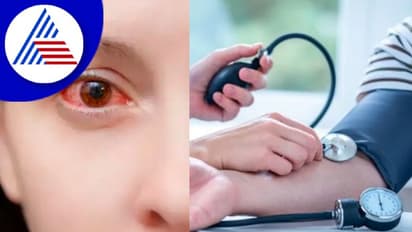 ಸೈಲೆಂಟ್ ಕಿಲ್ಲರ್ ಅಧಿಕ ಬಿಪಿಯ ಲಕ್ಷಣ ಕಣ್ಣಿನಲ್ಲೂ ಕಾಣಿಸ್ಕೊಳ್ಳುತ್ತೆ 