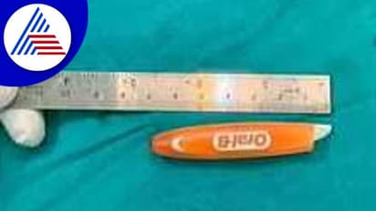 Hubballi: ಮಹಿಳೆಯ ಕಣ್ಣಿನ ಕೆಳಗೆ ಸಿಲುಕಿದ್ದ ಮುರಿದ ಟೂತ್ ಬ್ರಶ್ ಹೊರ ತೆಗೆದ ವೈದ್ಯರು