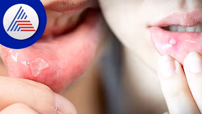 Health Tips :  ಬಾಯಿಯ ಈ ರೋಗ ದೊಡ್ಡ ಖಾಯಿಲೆಯ ಲಕ್ಷಣ