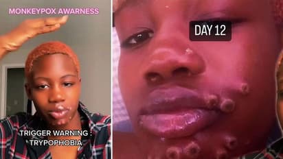 മങ്കിപോക്സ് പിടിപ്പെടാനുള്ള കാരണം അതായിരുന്നു;  തുറന്ന് പറഞ്ഞ് യുവതി  