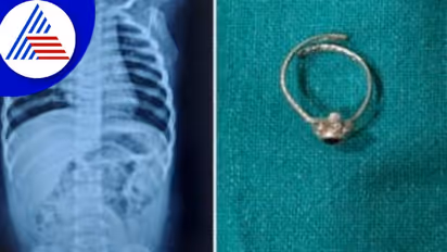 ಎದೆಹಾಲು ಕುಡಿಯದೆ ಅಳ್ತಿತ್ತು ಮಗು, ಎಕ್ಸ್ರೇ ತೆಗೆದ್ರೆ ಶ್ವಾಸಕೋಶದಲ್ಲಿತ್ತು ಕಾಲುಂಗುರ !