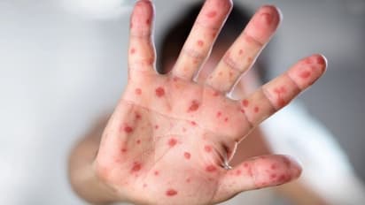 Tomato Flu : തക്കാളിപ്പനി എങ്ങനെ നേരിടാം; പ്രതിരോധ മാർഗങ്ങൾ നിർദേശിച്ച് കേന്ദ്രം