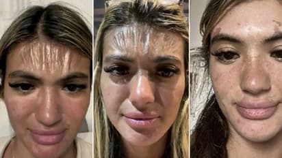 Sunburn : യുവതിയുടെ മുഖത്തിന്‍റെ നിറം മാറി, സ്കിൻ പ്ലാസ്റ്റിക് പോലെയായി; കാരണം എന്തെന്നറിയുമോ? 