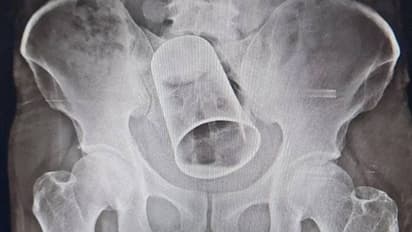 മദ്യലഹരിയില് യുവാവിന്റെ സ്വകാര്യഭാഗത്ത് സ്റ്റീല് ഗ്ലാസ് കുത്തിക്കയറ്റി, പുറത്തെടുത്തത് 10 ദിവസം കഴിഞ്ഞ്