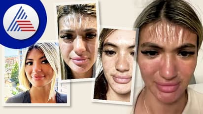 30 ನಿಮಿಷ ಬಿಸಿಲಿನಲ್ಲಿ ಮಲಗಿದ್ದ ಯುವತಿ, ಎದ್ದಾಗ ಮುಖ ನೋಡಿ ಗಾಬರಿಯೋ ಗಾಬರಿ !