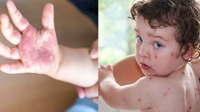 सावधान! छोटे बच्चों को Tomato Flu का अधिक खतरा, केंद्र ने जारी की गाइडलाइन,जानें लक्षण और इलाज