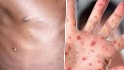 How is Tomato Flu different from Monkeypox? Know symptoms, treatment, and precautions here
