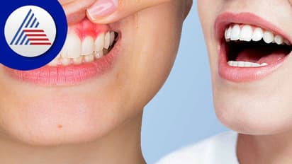 ಬಾಯಿ, ಹಲ್ಲಿನಷ್ಟೇ ಒಸಡಿನ ಆರೋಗ್ಯದ ಕಡೆಗೂ ಇರಲಿ ಕಾಳಜಿ