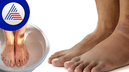 Home Remedies: ಊದಿಕೊಳ್ಳುವ ಪಾದಕ್ಕೆ ಇಲ್ಲಿದೆ ಪರಿಹಾರ