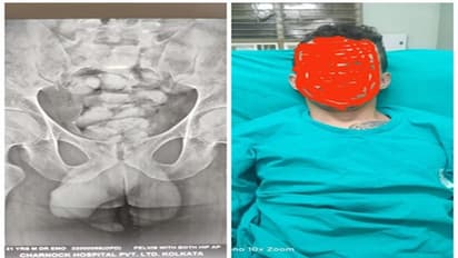 নিজের পাকস্থলীর মাধ্যমে মাদক পাচার, ব্রাজিলের যুবকের শরীর থেকে মিলল ৪৪টি মাদক-ক্যাপসুল 