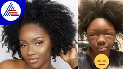 ಹೇರ್ ಡೈ ಅಲರ್ಜಿ, ಎಮೋಜಿಯಂತಾಯ್ತ ಮಹಿಳೆಯ ಮುಖ !