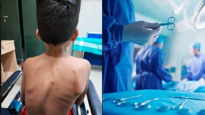 വളഞ്ഞു പോയ നട്ടെല്ല് നിവര്ത്തി; അപൂര്വ ശസ്ത്രക്രിയാ നേട്ടവുമായി കോട്ടയം മെഡിക്കല് കോളേജ്