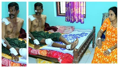 മരണക്കെണിയായി കുഴി; റോഡിലെ കുഴിയിൽ വീണ് സ്കൂട്ടർ യാത്രികരായ ദമ്പതികൾക്ക് പരിക്ക്  