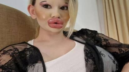 ലോകത്തിലേക്കും വച്ച് വലിയ ചുണ്ട്, ഇതിനായി 30 കുത്തിവയ്പ്പുകൾ, ലോകം നിറയെ ആരാധകർ 