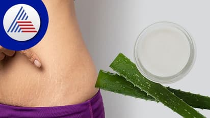 ಗರ್ಭಾವಸ್ಥೆಯ Stretch Mark ನಿರ್ಮೂಲನೆಗೆ ಮನೆಮದ್ದು!