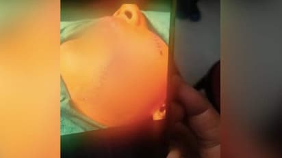 Dog Attack : 'പിറ്റ്ബുൾ' ആക്രമിച്ചു; പതിനൊന്നുകാരന്റെ മുഖത്ത് 200 സ്റ്റിച്ച്