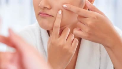 Whiteheads: വൈറ്റ് ഹെഡ്സിന് വിട; പരീക്ഷിക്കാം ഇക്കാര്യങ്ങള്...