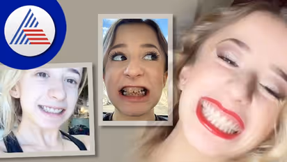 ಹಲ್ಲು ಹೀಗೆಲ್ಲಾ ಇರುತ್ತಾ ? ಓರೆಕೋರೆಯಲ್ಲ, Transparent Teeth 