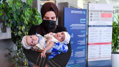 വേർപ്പെടുത്തൽ ശസ്ത്രക്രിയയുടെ സാധ്യത പരിശോധിക്കാന് ഇറാഖി സയാമീസ് ഇരട്ടകളെ സൗദി അറേബ്യയിലെത്തിച്ചു