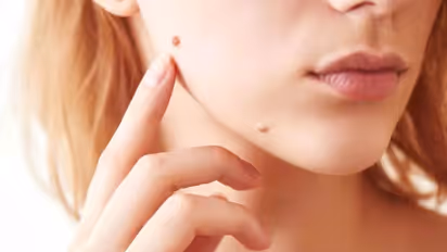 Warts: மருக்களை விழ வைக்க என்ன செய்யலாம்? இதோ வீட்டு வைத்திய முறைகள்!