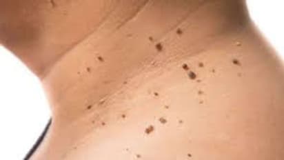 மருக்கள் உடனே உதிர்ந்து போக இந்த 1 துளியை வைத்தால் போதும்!! வாழ்நாளில் 'மருக்கள்' வரவே வராது!!! 