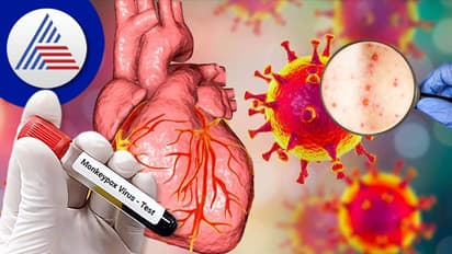 ಹರಡ್ತಿದೆ ಮಂಕಿಪಾಕ್ಸ್ ಸೋಂಕು, ಹೃದಯದ ಕಾಯಿಲೆಗೂ ಕಾರಣವಾಗುತ್ತಂತೆ !