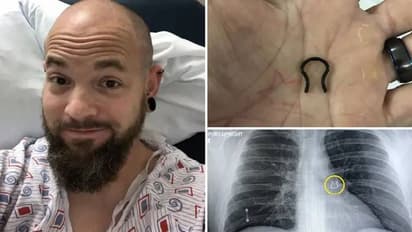 കാണാതായ നോസ്റിംഗ് ശ്വാസകോശത്തിൽ, അന്തംവിട്ട് യുവാവും ഡോക്ടർമാരും