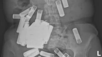 സ്ത്രീയുടെ വയറ്റിനകത്ത് നിന്ന് സർജറിയിലൂടെ നീക്കം ചെയ്തത് 55 ബാറ്ററികൾ!