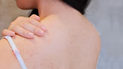 മുതുകിൽ വരുന്ന കുരു; ഇതൊഴിവാക്കാൻ ചെയ്യേണ്ടത്